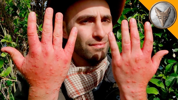 Worst Insect Stings