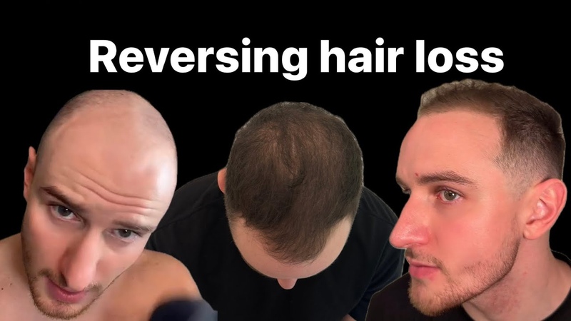 Reversing hair loss EP: 3 (with CEO DR Simon